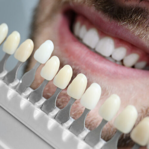 Young man choosing color of teeth at dentist, closeup